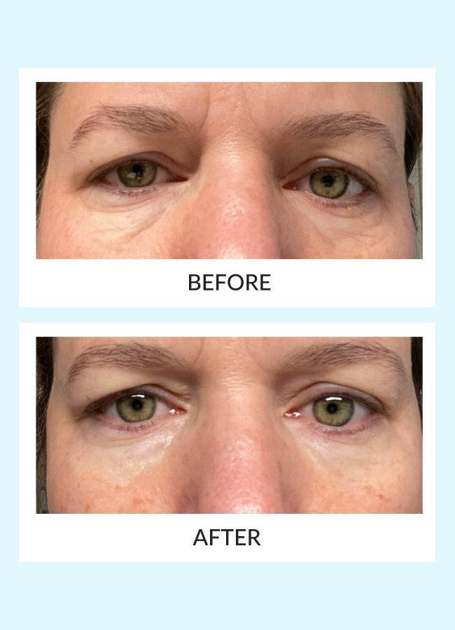 Reusable Eye Therapy Patches Solo